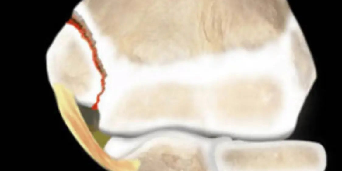 Youth Injury Series: Growth-Plate Injuries