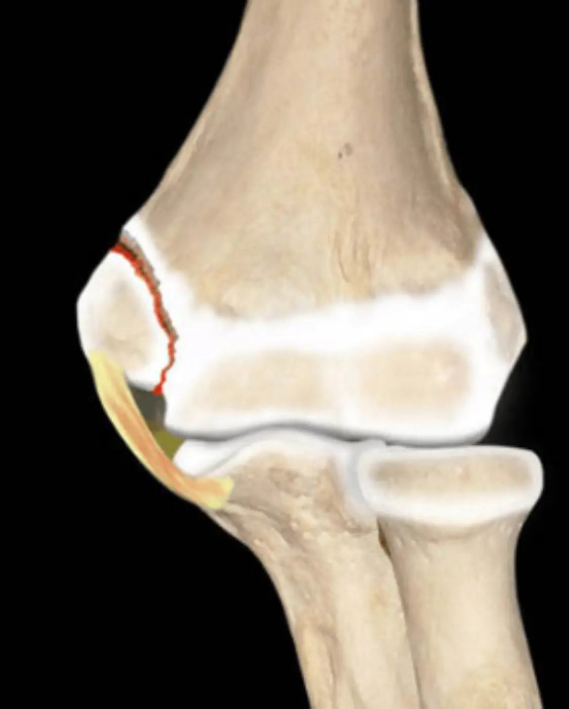 Youth Injury Series: Growth-Plate Injuries