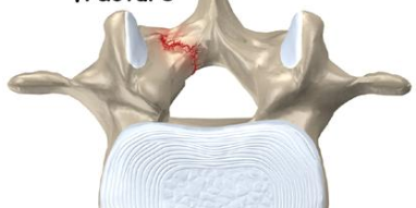 Youth Injury Series: Spondylolysis