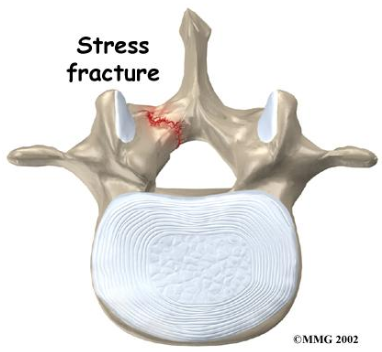 Youth Injury Series: Spondylolysis
