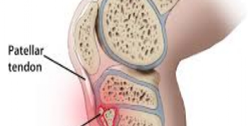 Youth Injury Series: Osgood-Schlatter's and Sever's Disease