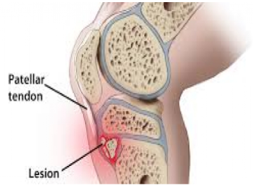 Youth Injury Series: Osgood-Schlatter's and Sever's Disease